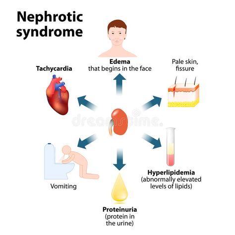 Image result for nephrotic syndrome Focal Segmental Glomerulosclerosis, Pediatric Nurse Practitioner, Nephrotic Syndrome, Low Estrogen Symptoms, Basic Anatomy And Physiology, Med School Motivation, Nursing School Notes, Medical School Essentials, Nursing Tips