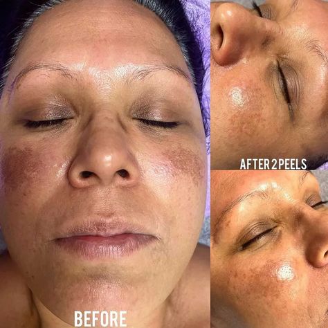 Chemical Burn On Face, Chemical Peel Before And After, Chemical Face Peel, Vi Peel, Chemical Burn, Chemical Peel At Home, Face Peel, Acid Peel, Chemical Peels