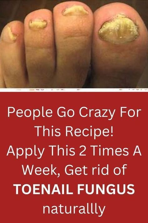 Infected Toenail, Toenail Health, Toenail Fungal Infection, Fingernail Fungus, Toenail Fungus Remedies, Nail Problems, Nail Infection, Fungal Nail, Toenail Fungus