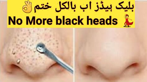 No more blackheads Remedy For Blackheads, How To Remove Blackheads, For Blackheads, Blackhead Remedies, To Remove Blackheads, Remove Blackheads, Diy Tops, Natural Home, Blackhead Remover