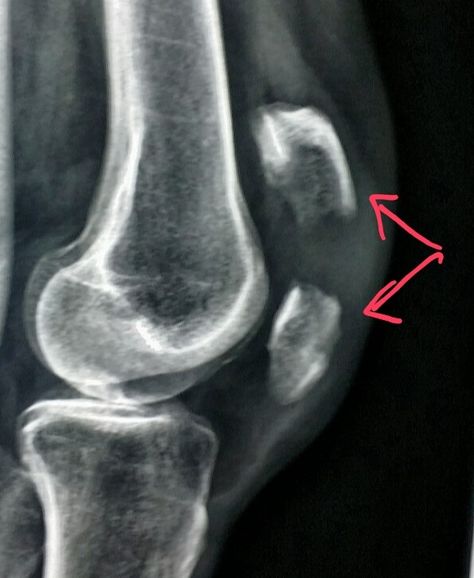 #Knee xray shows a #fracture through the #kneecap (#patella) in a #patient who #fell.  #radiology #radiologist #pain #injury Knee Xray, Knee Cap, Radiology, X Ray, Neon Signs