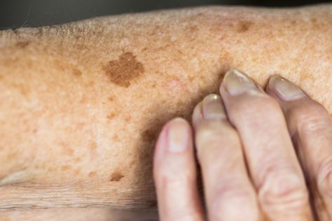 What Does Squamous Cell Carcinoma Look Like? Liver Spot, Basal Cell, Skin Moles, Squamous Cell, Bleaching Cream, Oncology Nursing, Aloe Gel, Age Spots, Houston