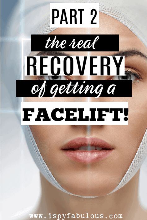 facelift recovery Facelift Recovery, Gallbladder Surgery, Face Lift Surgery, Good For Her, Surgery Recovery, After Pictures, Post Surgery, Face Lift, Before And After Pictures