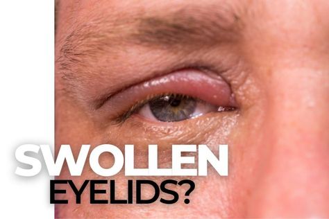 ￼Blepharitis: The Most Common Cause of Dry Eye - EZOnTheEyes Conjuctivita Eye, Dry Eyelids Remedy, Swollen Eyes From Allergies, Eye Infection Remedies, Sty In Eye Remedies, Stye Remedies Fast, Swollen Eyelids Remedy, Swollen Eye Remedies, Stye Remedies