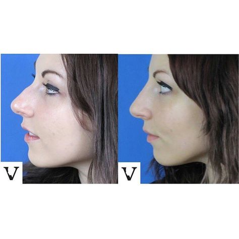 👃 Nose feeling a little bumpy? Smooth things over with a Liquid Rhinoplasty! Our patient wanted to enhance their natural beauty without going under the knife. With a few expertly placed fillers, we were able to subtly smooth out the dorsal hump, creating a more balanced and refined look. Love the results? Contact us today to schedule your consultation! ☎️ 617-795-0201 📧 info@VisageSculpture.com 💻 www.VisageSculpture.com #VisageSculpture #LiquidRhinoplasty #NonSurgicalRhinoplasty #FacialF... Liquid Rhinoplasty, Under The Knife, Natural Beauty, Beauty, Quick Saves