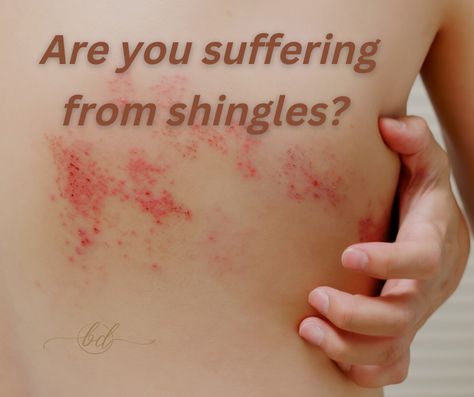 Shingles Symptoms Signs, What Causes Shingles, Heat Rash Remedy, Skin Rashes Pictures, Skin Disease Pictures, Shingles Relief, Shingles Rash, Rashes Remedies, How To Become Healthy