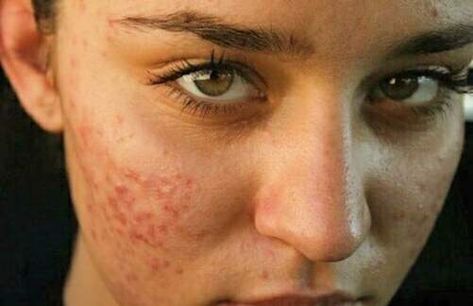 Why Acne Doesn’t Make You Any Less Beautiful Girl With Acne, Acne Treatment Overnight, Pimples Under The Skin, Back Acne Treatment, Bad Acne, Pele Natural, Natural Acne, Natural Acne Remedies, Best Teeth Whitening