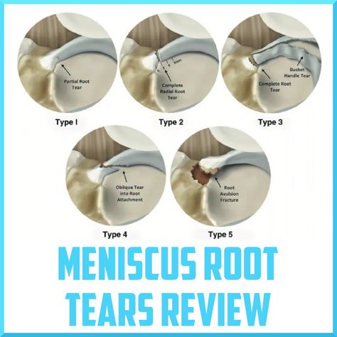 Meniscus Root Tear Recovery, Medial Meniscus, Arthroscopic Knee Surgery, Meniscal Tear, Sagittal Plane, Cruciate Ligament, Magnetic Resonance Imaging, Knee Surgery, Magnetic Resonance