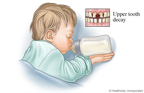 Just say “No” to bottles in bed. Never put your baby to sleep with a bottle or sippy cup filled with milk, formula, fruit juice, or other sweet liquid. The sugar in these beverages can cause cavities in your baby’s teeth, leading to �“baby bottle tooth decay.” If you must give your baby a bottle to sleep fill the bottle with water instead. Baby Bottle Tooth Decay, Dental Education, Remedies For Tooth Ache, Dental Fun, Dental Facts, Pediatric Dentist, Best Teeth Whitening, Baby To Sleep, Dental Humor