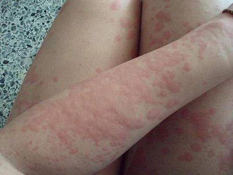 What do bed bugs, tick bites and mosquito bites all have in common? For the most part, they all leave some types of rashes of some kind that shouldn't be Heat Rash Remedy, Skin Rashes Pictures, They All Leave, Prickly Heat Rash, Leg Rash, Vitamin Deficiency Symptoms, Body Rash, Rash On Face, Rashes Remedies