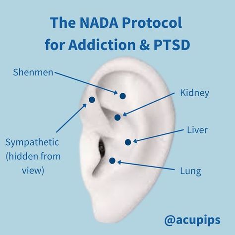 Nada Protocol, Auscultation Points, Accupressure Point For Nausea, Accupressure Point For Allergies, Sujok Therapy Acupressure Points, Ear Acupressure Points, Acupressure Chart, Ynsa Scalp Acupuncture, Auricular Acupuncture