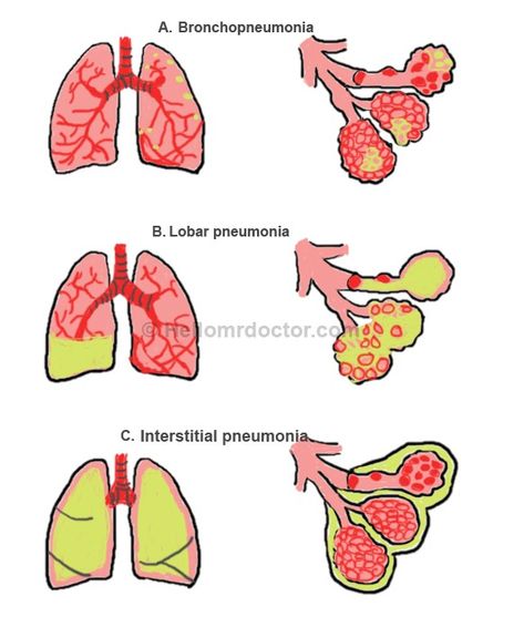 bronchopneumonia Remedies For Pneumonia, Biomedical Illustration, Medsurg Nursing, Endocrine System Hormones, Respiratory System Anatomy, Lungs Anatomy, Home Remedies For Bronchitis, Lung Anatomy, Lung Sounds