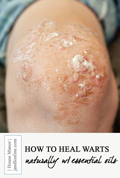 Getting Rid of Warts Naturally with Essential Oils - JandLOnline Flat Warts How To Get Rid Of, Warts How To Get Rid Of, Diy Wart Removal, Flat Warts, Home Remedies For Warts, Remove Skin Tags Naturally, Warts Remedy, Mole Removal, Get Rid Of Warts