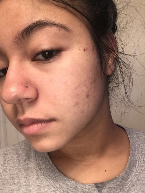 This is my first day using Halo Beauty Kiwi Seed Booster. I struggle with dry skin and acne breakout my whole life, but once I hit 20, my acne got even worst. I’ve tried everything and now I am seeing if adding the Halo Beauty supplements to my daily regimen will be the trick to what my struggling skin needs. #skincare #halobeauty #myskincarejourney Strawberry Freckles, Kiwi Seeds, Acne Beauty, Clean Blackheads, Beauty Supplements, Acne Breakout, Skin Care Order, Effective Skin Care Products, Beauty Regimen