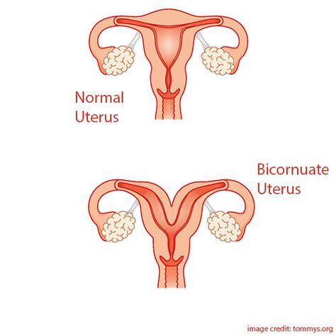 Bicornuate Uterus and it’s impact on a woman’s fertility Heart Shaped Uterus, Bicornuate Uterus, Uterine Polyps, Menstrual Health, Menstrual Cup, Twin Pregnancy, Baby Grows, Us Images, Fertility