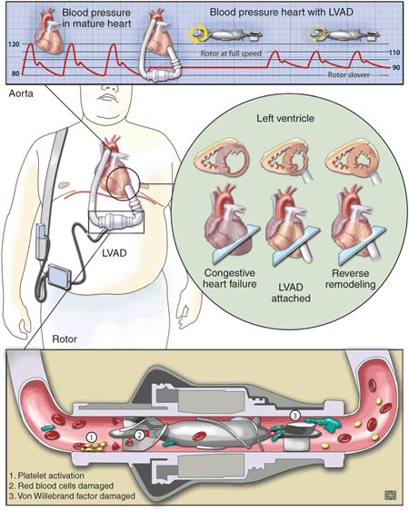 LVAD Cardiac Perfusion Technology, Cardiac Pathology, Nursing Terminology, Cardiology Study, Medicine Technology, Nursing Instructor, Nurse Cartoon, Nursing Cheat, Pharmacy Student