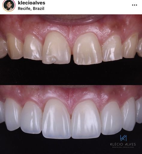 Before and after porcelain Veneers from doctor klecioalves.  The top photos is the before picture, the teeth are yellow and chipped. The Bottom photo is the after picture which is a perfect white smile. Teeth Surgery Before And After, Perfect Smile Teeth Porcelain Veneers, Prosthodontics Day Posters, Dental Veneers Before And After, Teeth Veneers Before And After, Dental Crowns Before And After, Dental Before And After, Porcelain Veneers Before And After, Composite Veneers Before And After