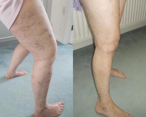 Heal Your Varicose Veins with a Mix of Aloe Vera, Carrot and Apple Cider Vinegar – RECIPE Thread Veins, Home Remedies For Spiders, Leg Ulcers, Varicose Vein Remedy, Venous Insufficiency, Cypress Essential Oil, Before After Photo, Smart Things, Cider Vinegar