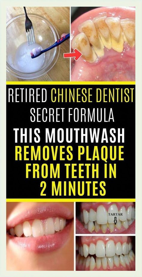 Remove Plaque From Your Teeth Just In 2 Minutes! Remove Plaque From Teeth, Heal Cavities, Dental Implants Cost, Teeth Implants, Health Heal, Oral Care Routine, Receding Gums, Oral Health Care, Dental Hygienist