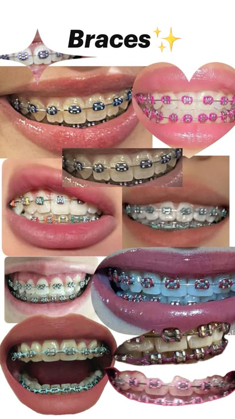 Teeth Braces Before And After, Lime Green Braces, Best Braces Colors Ideas, Color Braces Ideas, Braces Colors Ideas Dark Skin, Hot Pink Braces, Aesthetic Braces, Navy Blue Braces, Pretty Braces