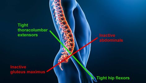 How To Correct Lordosis, Lordosis Correction Exercises, Lower Crossed Syndrome Exercises, Upper Cross Syndrome Exercises, Somatic Hip Opening Exercises, Snapping Hip Syndrome, Upper Cross Syndrome, Iliotibial Band, Back Lift