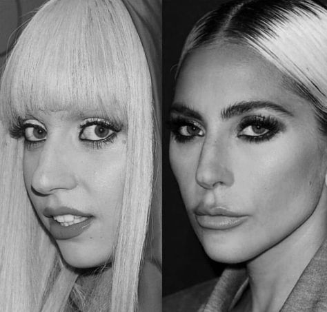 Before and after surgery Lady Gaga Nose, Lady Gaga Before, Before And After Nose Job, Boyfriend Kissing, Kylie Jenner Lips, Kylie Lip Kit, Cosmetic Dermatology, Celebrity Plastic Surgery, Kylie Cosmetic