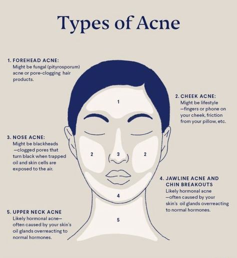 Meaning Of Pimples On Face, Acne Above Lip Meaning, Face Breakout Chart, Pimples And Their Meaning, Acne Chin And Jaw, Pimple Meaning Face Mapping, Pimple On Face Meaning Signs, Acne Causes On Face Chart, Acne Location Meaning Face Mapping