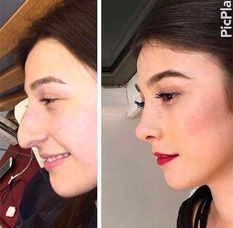 Possibly the best nose job I've ever seen Nose Plastic Surgery, Nose Surgery Rhinoplasty, Rhinoplasty Nose Jobs, Nose Reshaping, Plastic Surgery Gone Wrong, Rhinoplasty Surgery, Pretty Nose, Perfect Nose, Nose Surgery