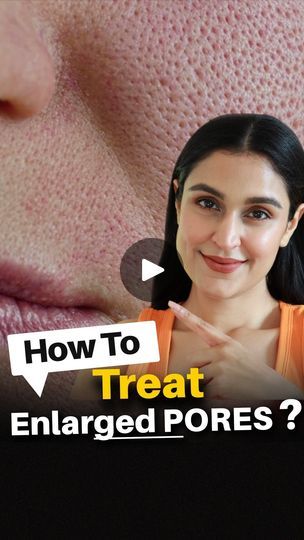 28K views · 1.5K reactions | How to Treat ENLARGED PORES & TEXTURED SKIN? | #AD  SAVE & COME BACK TO IT WHEN YOU NEED IT!  Few common skin concerns in India are enlarged pores, textured skin, uneven skin tone and hyperpigmentation.   1 ingredient that will cater to these skin needs is Niacinamide & if you have followed me for a while you must be aware that I love how well @plumgoodness has formulated both their Niacinamide serums.  Try their 10% Niacinamide face serum 4-5 times in your AM routine  and incorporate their 2% Salicylic Acid in your PM routine 3 times a week. This routine will help treat the closed comedones and clogged pores as well.  You can use my coupon code to get 15% off on your Plum Goodness purchase CHETALI.  #1MillionBrightFaces #SwitchToTheBrightSide #PlumNiacinamideS How To Close Pores On Face, How To Close Pores, Closed Comedones, Am Routine, Pm Routine, Textured Skin, Open Pores, Facial Products, Tighter Skin