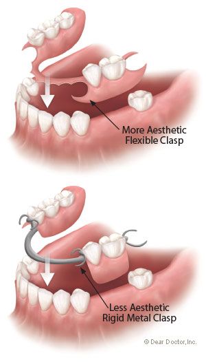 Types of flexible partial dentures. Dental Assistant Study, Dental Images, Dental Anatomy, Kedokteran Gigi, Partial Dentures, Dental Facts, Tooth Replacement, Teeth Implants, Dental Bridge