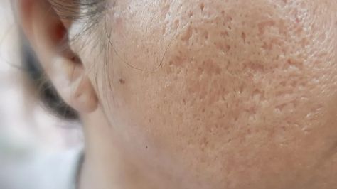 How to get rid of boxcar scars: Treatments for acne scars Face Acne Remedies, Nodule Acne, Best Acne Scar Removal, Skin And Hair Clinic, Scar Removal Cream, Types Of Acne, Acne Scar Removal, Skin Resurfacing, Face Acne