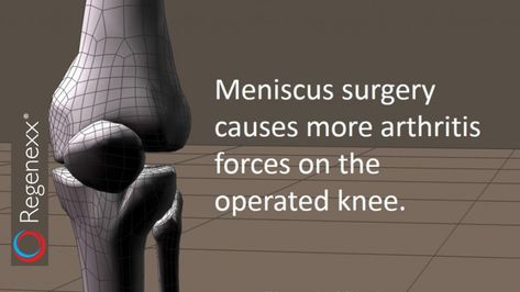 Meniscus Surgery Arthritis: Removing a Small Amount of Meniscus Causes Problems Meniscus Surgery, Ligament Tear, Knee Surgery, What Happens When You, Stem Cells, Surgery, Health