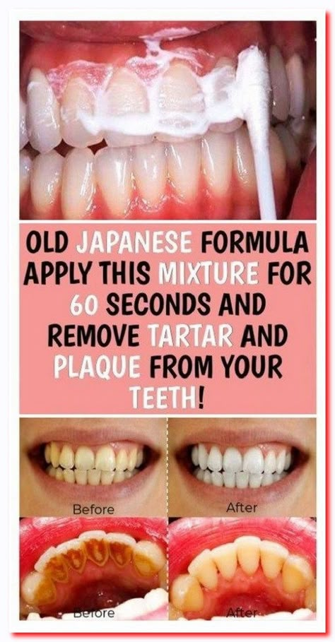 OLD JAPANESE FORMULA APPLY THIS MIXTURE FOR 60 SECONDS AND REMOVE TARTAR AND PLAQUE FROM YOUR TEETH! Tartar Removal, Teeth Whitening Diy, Dental Cavities, Teeth Health, Tooth Sensitivity, Oral Care Routine, Oral Health Care, Tooth Decay, Healthy Teeth