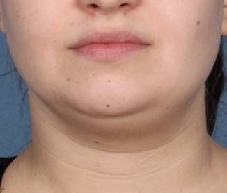 Case 100177 - Before and After Kybella Photos Belkyra Before And After, Kybella Before And After, Facial Plastic Surgery, Guest Hair, Brow Lift, Cool Sculpting, Facial Plastic, Anti Aging Beauty, Cosmetic Procedures