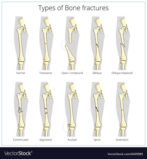 Medical Skeleton, Stitches Medical, Types Of Fractures, Types Of Bones, Radiology Technician, Skeleton Anatomy, Basic Anatomy And Physiology, Bone Fracture, Vet Medicine