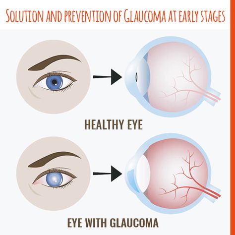 Optic Nerve, Gentlemans Guide, Nerve Damage, Healthy Eyes, Nerve, Disease, Brain, Quick Saves