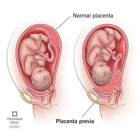 Placenta Previa: Symptoms, Causes & Treatments Previa Placenta Pregnancy, Anterior Placenta, Placenta Accreta, Trimester By Weeks, Months Of Pregnancy, Emergency C Section, Gestational Age, Premature Birth, Liver Detoxification