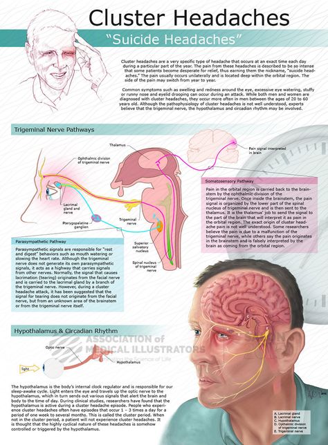 Cluster Headache Causes, Cluster Migraines, Cluster Headache Relief, Cluster Headache, Migraine Help, Forward Head Posture Exercises, Neck And Shoulder Muscles, Throbbing Headache, Migraine Pain