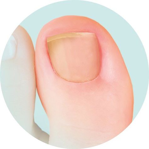 Nail Infection Bluish Nails, White Spots On Nails, Ugly Toenails, Toenail Problems, Yellow Toe Nails, Pale Nails, Toenail Health, Nail Signs, Nail Problems