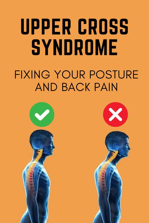 Unlock the Secret to Better Posture! 🌟 Dive into our latest blog that delves deep into Upper Cross Syndrome – the culprit behind poor posture. Discover effective tips and exercises to straighten up your stance and wave goodbye to those pesky aches. Click to read more! 💻👩‍💻 Upper And Lower Cross Syndrome, Upper Cross Syndrome, Chin Tuck, Shoulder Impingement, Fix Your Posture, Muscle Knots, Forward Head Posture, Trigger Point Therapy, Muscle Imbalance