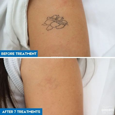 Tattoo Removal Before And After, 7 Tattoo, Laser Tattoo, Laser Tattoo Removal, Tattoo Removal, The Client, S Tattoo, A Tattoo, New Tattoos