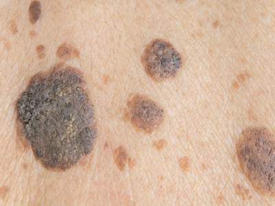 Watch for These Advanced Melanoma Warning Signs | HealthCentral Seborrheic Keratosis, Remove Skin Tags Naturally, Brown Spots On Skin, Skin Moles, Mole Removal, Skin Growths, Skin Tags, Skin Spots, Skin Disorders