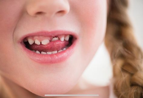 What Should you do If your child’s tooth is knocked loose? https://health.clevelandclinic.org/what-should-i-do-if-my-childs-tooth-is-knocked-loose/?utm_campaign=crowdfire&utm_content=crowdfire&utm_medium=social&utm_source=pinterest #dentist Loose Teeth, Teeth Remedies, Knocked Loose, Loose Tooth, Dental Emergency, Pediatric Dentist, Oil Pulling, Good Mental Health, Pediatrics