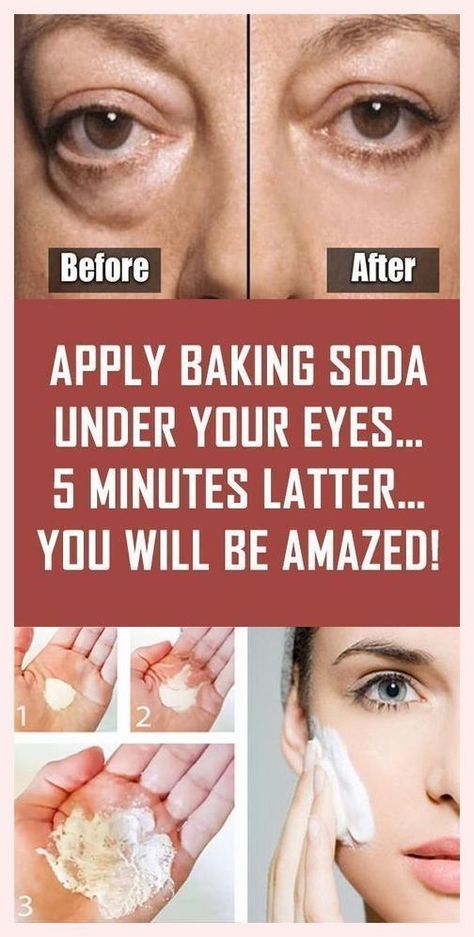 Baking Soda Under Eyes, Puffy Eyes Remedy, Baking Soda Face Mask, Wrinkles Remedies Face, Bags Under Eyes, Dark Spots Remedies, Wrinkles Remedies, Anti Aging Remedies, Baking Soda Face