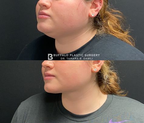 Facial Lipo Before And After, Neck Lipo Before And After, Chin Lipo Before And After, Plastic Aesthetic, Lipo Before And After, Fat Transfer, Full Lips, Buffalo New York, Nose Job