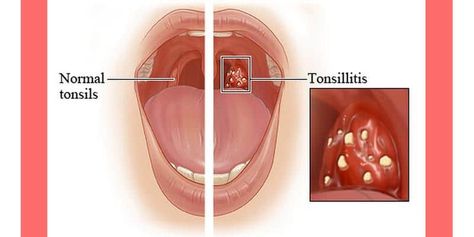 Acute Tonsilitis - Petr Zacharias - Hpathy.com Crumble Recipe, Sore Throat, Small Jars, Homeopathy, Natural Medicine, Food Guide, Food Print, Natural Remedies, Beauty And Personal Care