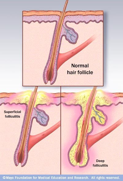 Folliculitis a skin condition in which hair follicles become inflamed. It's usually caused by a bacterial or fungal infection.  Diabetics more prone to get this. Stages Of Hair Growth, Infected Hair Follicle, Hair Growth Pills, Remove Skin Tags Naturally, Electrolysis Hair Removal, Hair Growth Cycle, At Home Hair Removal, Home Remedies For Hair, Hair Shedding