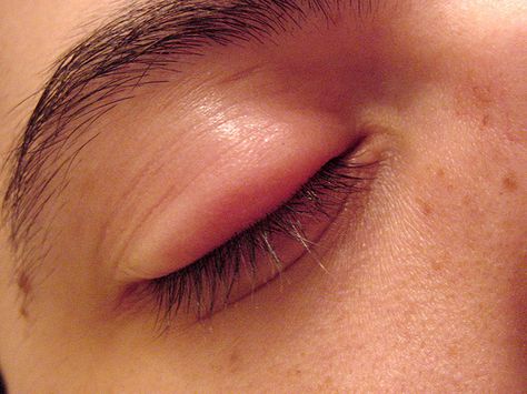 Swollen Eye Swollen Eyelids Remedy, Swollen Eye Remedies, Stye Remedy, Swollen Eye, Elderly Love, Homemade Acne Remedies, Stye Remedies, Swollen Eyelid, Eye Stye Remedies