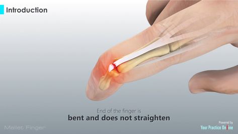 Mallet finger is a condition where the end of the finger is bent and does not straighten. It occurs when the extensor tendon on the back of the finger is damaged. The finger joint is a hinge-joint that allows bending and straightening of the fingers. Each finger is composed of 3 phalanges bones, joined by 2 interphalangeal joints (IP joints). The joint near the base of the finger is called the proximal IP joint or PIP joint, and the joint near the tip of the finger is called the distal IP joint Mallet Finger, Medical Videos, Patient Education, Hand Wrist, Medical Professionals, Natural Healing, Bending, Bones, Cool Stuff