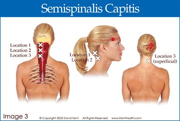 Semispinalis Capitis, Forehead Photo, Punkty Spustowe, Message Therapy, Hip Flexor Exercises, Referred Pain, Trigger Point Therapy, Head Pain, Hip Flexor Stretch